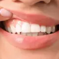 Are Dental Implants the Best Way to Replace Missing Teeth?